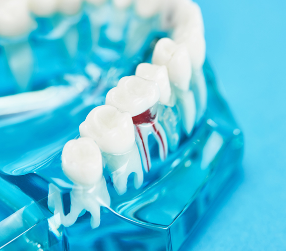 根管治療（歯内療法）