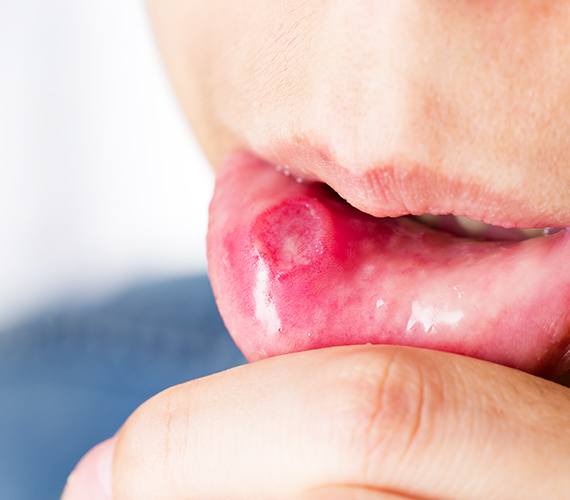 非接触の口腔がん検診機器を完備