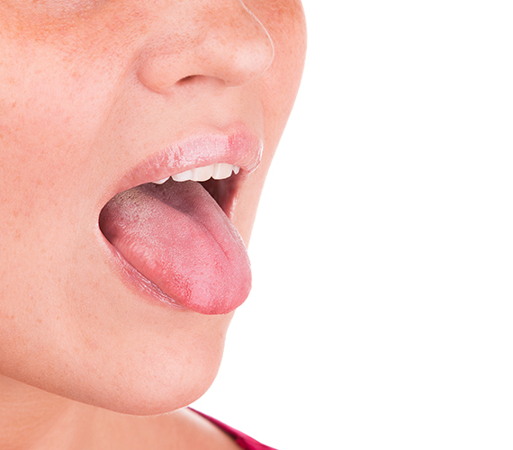口内炎